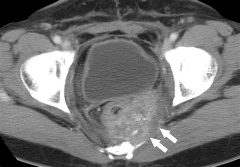 Uterine Cervical Carcinoma After Therapy Ct And Mr Imaging Findings Radiographics