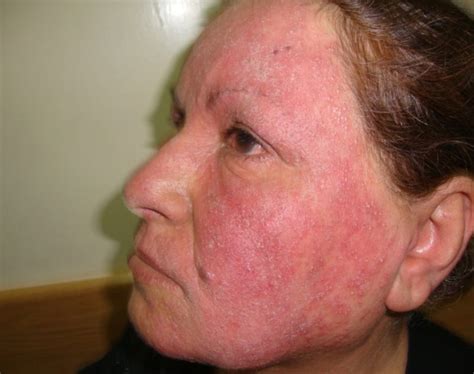 Acne And Rosacea Dermatology Oasis