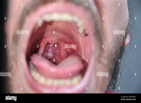 What Does A Normal Healthy Throat Look Like