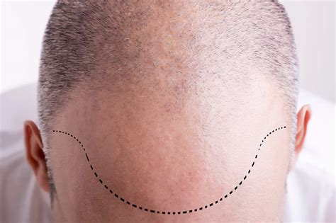 Sapphire Hair Clinic Hair Transplant In Turkey Optimal Results At
