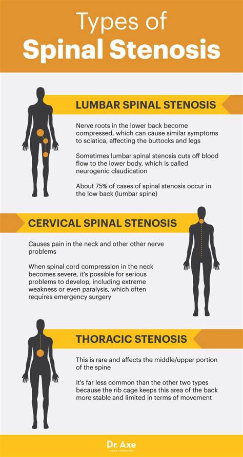 Lumbar Spinal Stenosis Stenosis Of The Spine Cervical Spinal Stenosis