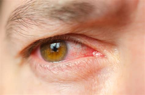 Infections Oculaires Types Symptômes Et Traitement All About Vision