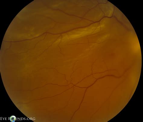 Atlas Entry Retinal Breaksholes With Proliferative Vitreoretinopathy