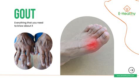 Gout Symptoms Diagnosis Causes And Treatment E Healthy Info
