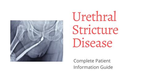 Male Urethral Stricture Symptoms Investigations And Treatment Guide
