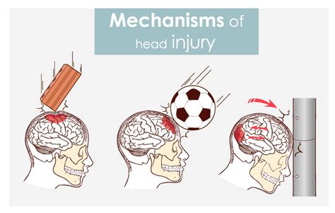 Ask Dr John Esq How Are Concussions Assessed Diller Law Personal