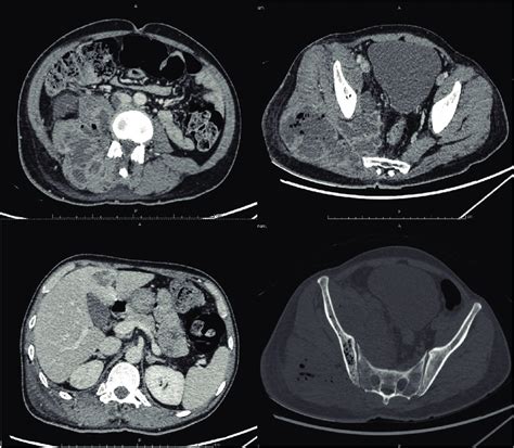 Ct Scan Whole Abdomen Of This Patient Demonstrating A Large