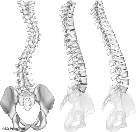 3d Models Of The Spine Of A Patient With Neural Axis Associated Download Scientific Diagram