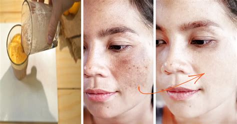 Potato Juice Home Remedy To Get Rid Of Dark Spots And Pigmentation Fast