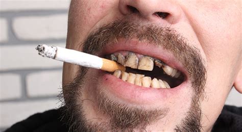 Mouth Sores From Chewing Tobacco Tidatabase
