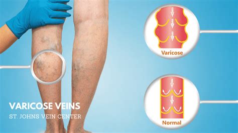 Varicose Veins Causes Prevention Treatment Options