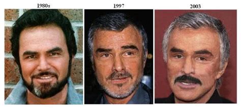 Burt Reynolds Plastic Surgery