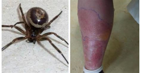 Like most spiders, the false widow's bite is venomous, but it almost always only has a mild effect on humans. Warning after woman is hospitalised for a week after False ...