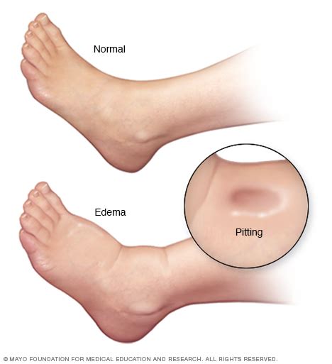 Edema Disease Reference Guide