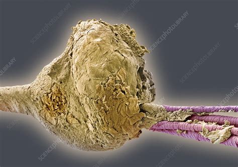 Blackheads Magnified