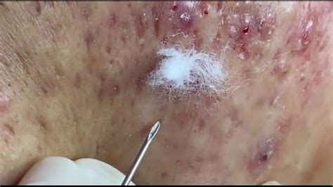 Acne Removal Treatment Super Satisfying Blackhead Removal 5 Youtube