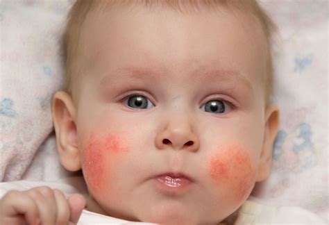 Hautausschlag Im Gesicht Des Babys Arten Ursachen Und Behandlung