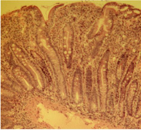 Figure 1 Small Bowel Biopsy Showing Typical Features Of Untreated