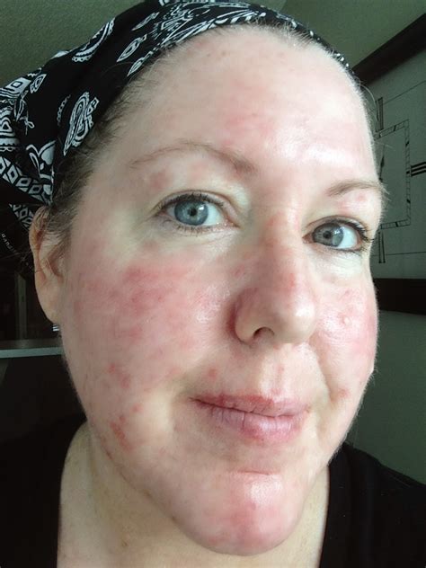 My Journey Through Topical Chemotherapy Fluorouracil 5 Cream And