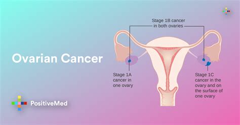 Ovarian Cancer All You Need To Know Symptoms And Treatments