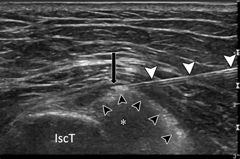 Us Guided Musculoskeletal Interventions In The Hip With Mri And Us