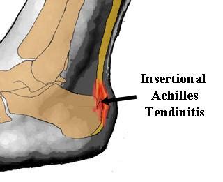 A physiotherapist might carry out. Racing Stripes: Insertional Achilles Tendonitis Recovery