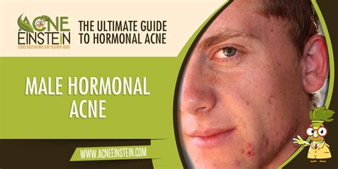 Male Hormonal Acne The Ultimate Guide To Hormonal Acne Acne Einstein
