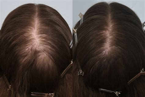 Hair loss is one of the toughest medical challenges because of its complex etiology and huge impact on esthetics in both females and males. Hair Loss Dermatology Clinic Dublin | HRBR