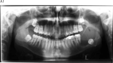 Dentigerous Cyst Affecting The Left Mandible Of A 15 Ye Open I