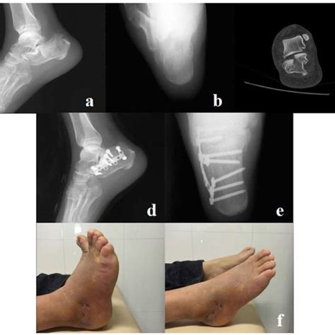 A 36 Year Old Male Patient Had A Right Calcaneal Fracture As A Result