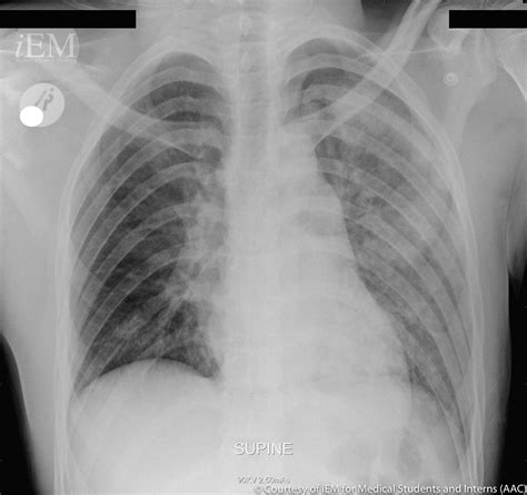 992 Chest Xray Left Apical Pneumothorax 1 A Photo On Flickriver