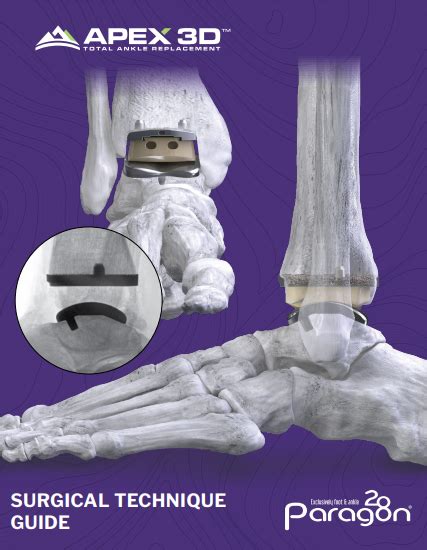 Apex 3d™ Total Ankle Replacement System Paragon 28