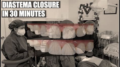 Check spelling or type a new query. Teeth Gap Closed in 30 minutes (no braces treatment ...
