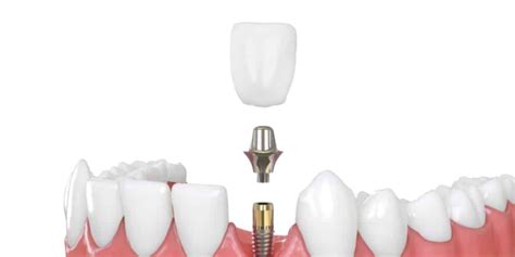 Dental Implants Cost Per Tooth Asli Tarcan Clinic