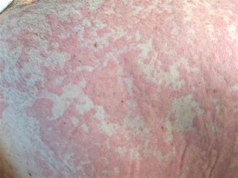 Hives A Common Rash With Many Possible Causes 2022