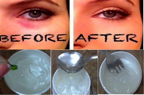 Do It Yourself The Most Effective Cream Anti Dark Circles Under The