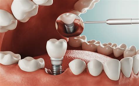 Do Gums Grow Around Dental Implants