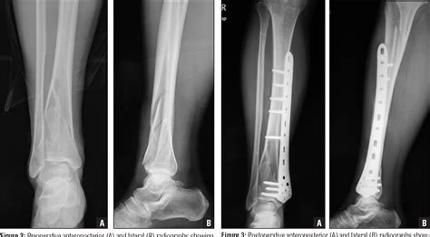 Figure 4 From Surgical Treatment Of Extra Articular Or Simple Intra