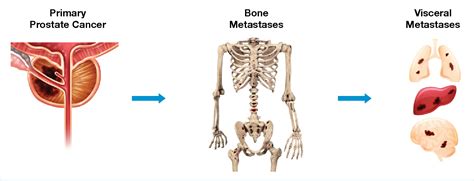 Pdf Bone Metastases And Mortality In Prostate Cancer Can We Be Doing