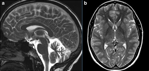 Brain Mri Of Patient Iii2 A Midsagittal T2 Weighted Image Shows Mild