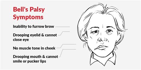 Signs and symptoms of bell's palsy. Drooping Face: How to Treat Bell's Palsy with Physiotherapy