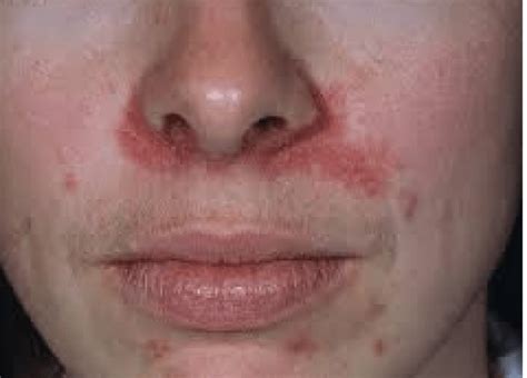 9 причин шелушащейся и сухой кожи вокруг носа включая лечение