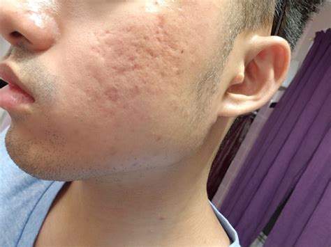 Acne Scars Too Severe Is There Any Hope For Me Scar Treatments