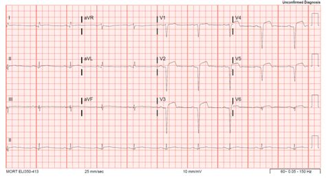 The ecg changes associated with acute pulmonary embolism may be seen in any condition that causes acute pulmonary hypertension, including hypoxia causing pulmonary hypoxic vasoconstriction. emDOCs.net - Emergency Medicine EducationECG Pointers ...