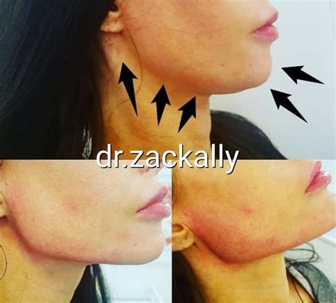 To get even more of a chiseled jawline, apply an astringent toner to your jawline every night so your skin doesn't sag. Pin on Chin & Jawline Sculpting