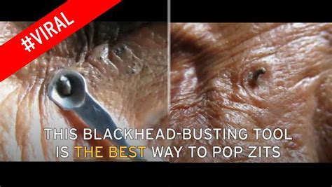 All You Need To Know About Blackhead Removal By The Doctor Who