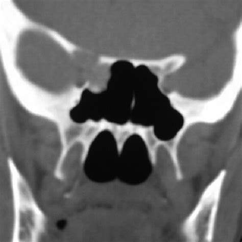 Ct Shows Expansile Lytic Lesion Of The Right Skull Base And Anterior