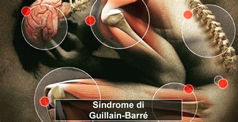 Published online 15 july 2014; Sindrome di Guillain-Barré - www.neuropsicomotricista.it