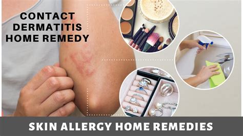 Skin Allergy Home Remedies Contact Dermatitis Home Remedy Youtube