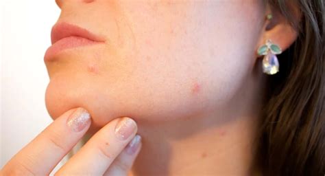 Preventing Acne 5 Key Tips For Avoiding Breakouts In Newsweekly